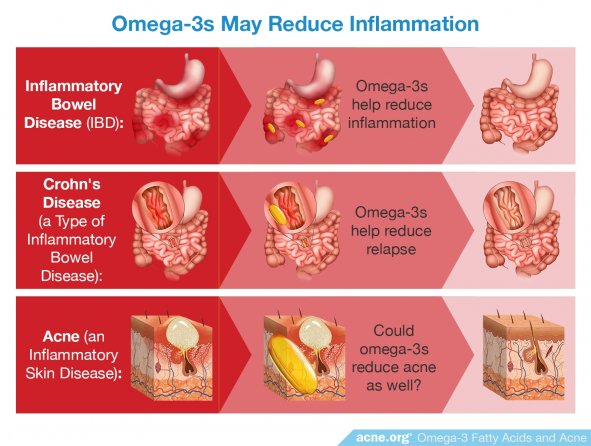 Omega-3s May Reduce Inflammation