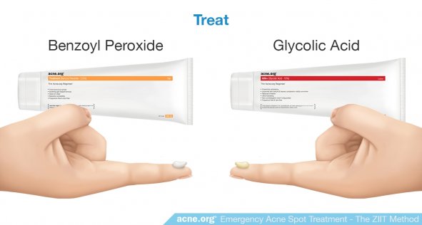 Treat: Benzoyl Peroxide and Glycolic Acid