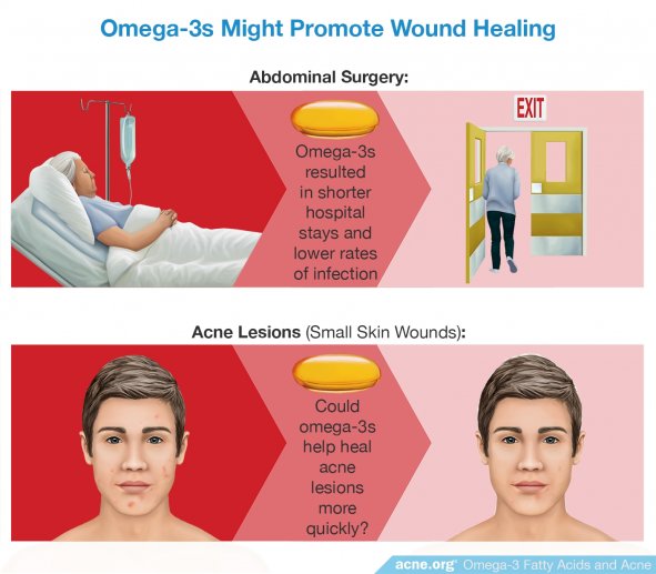 Omega-3s Might Promote Wound Healing