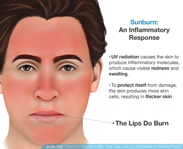 Sunburn: An Inflammatory Response