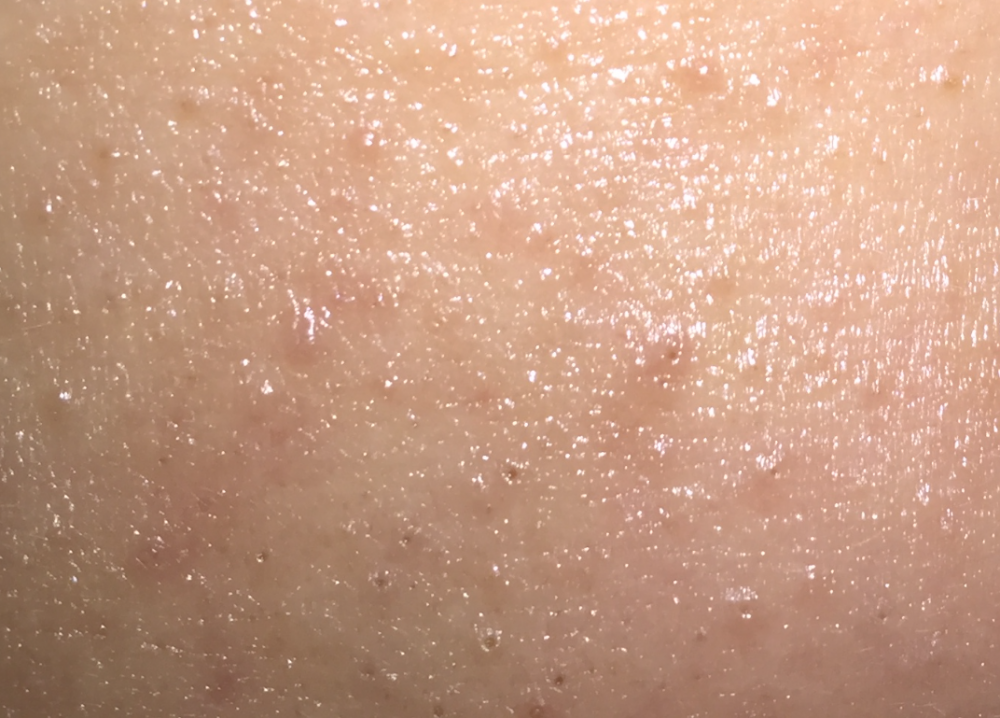 unknownacne.png