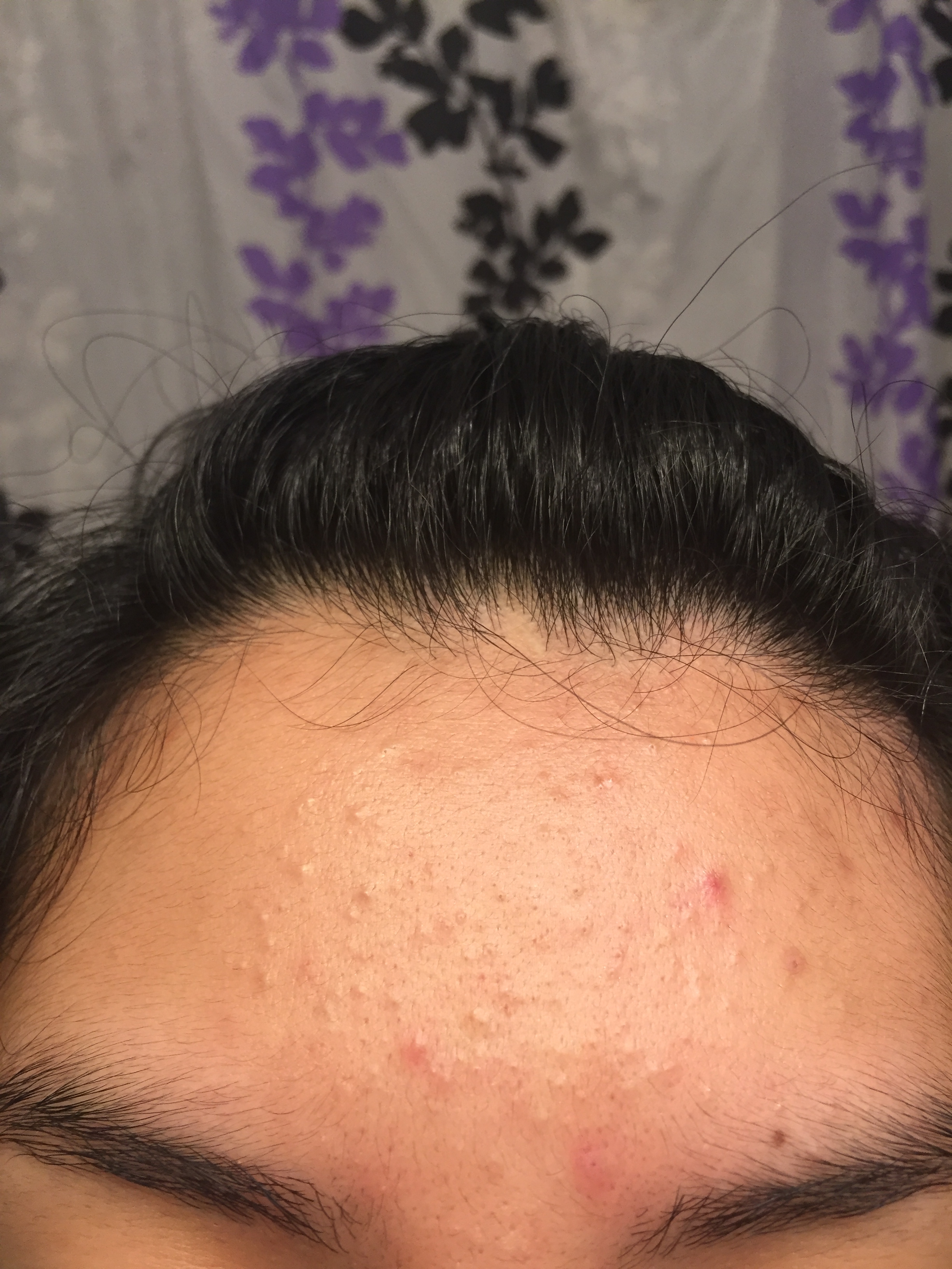 How Do You Get Rid Of Stubborn Closed Comedoneshelp General Acne