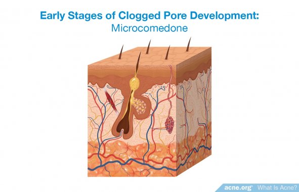 Early Stages of Clogged Pore Development: Microcomedone