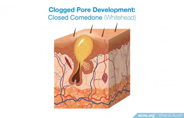 Clogged Pore Development: Comedone (Whitehead)