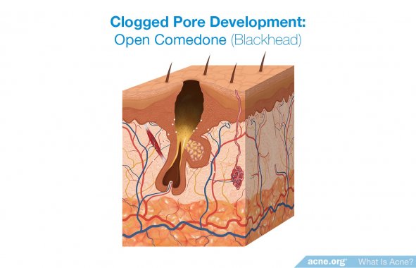 Clogged Pore Development: Open Comedone (Blackhead)