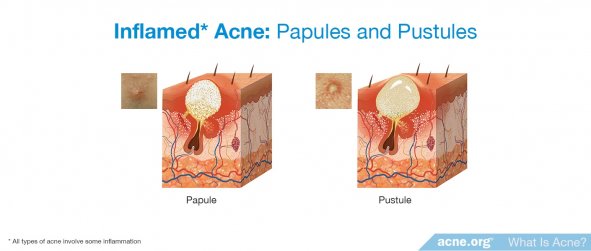 Inflamed Acne: Papules and Pustules