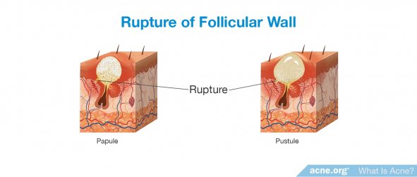 Rupture of Follicular Wall