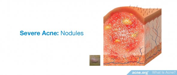 Severe Acne: Nodules