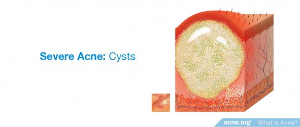 Severe Acne: Cysts