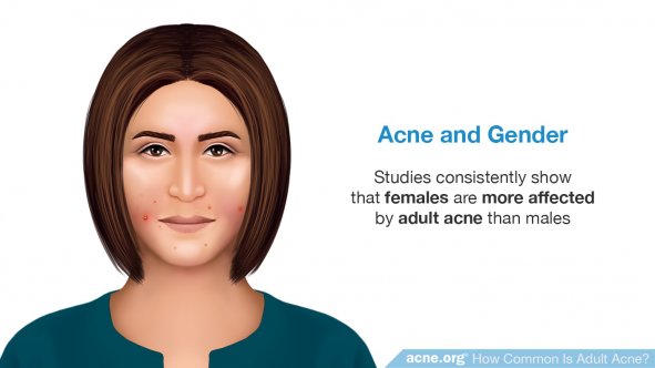 Acne and Gender
