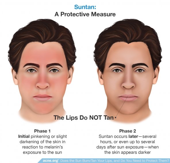 Suntan: A Protective Measure