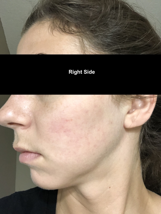 6 Months POST ACCUTANE - A Journey on Accutane (Epuris ...