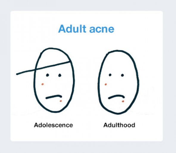 Adult Acne