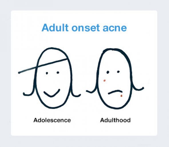 Adult Onset Acne