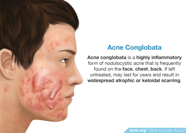Acne Conglobata