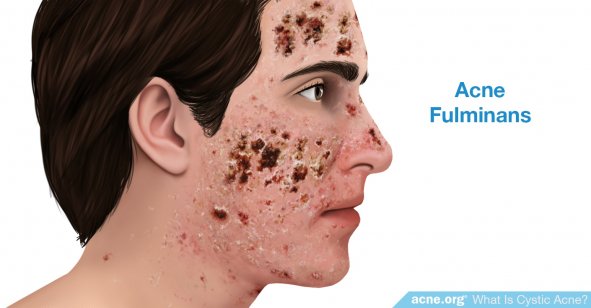 Acne Fulminans