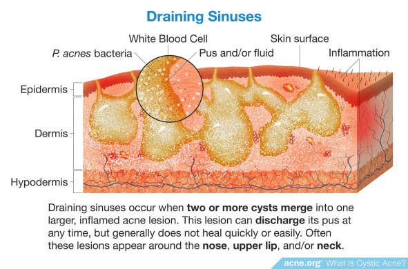 Draining Sinuses