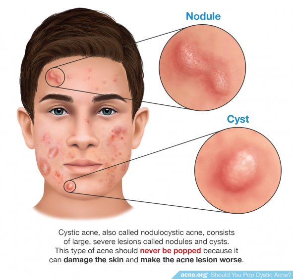 Cystic Acne Should Never Be Popped