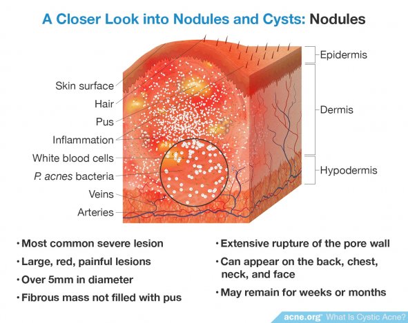 A Closer Look into Nodules and Cysts: Nodules