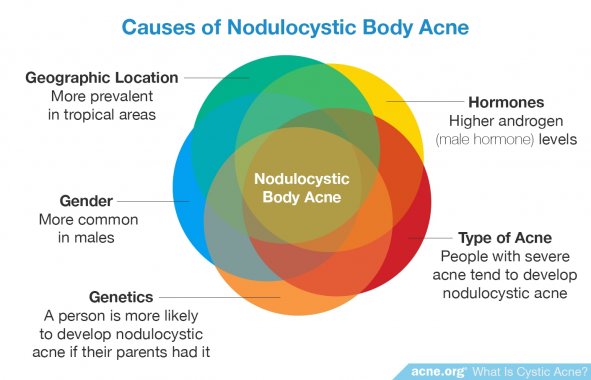 Causes of Nodulocystic Body Acne