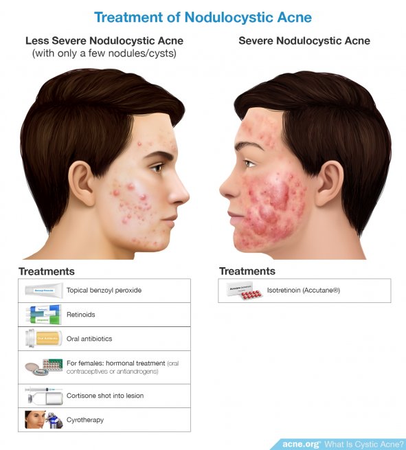 Treatment of Nodulocystic Acne