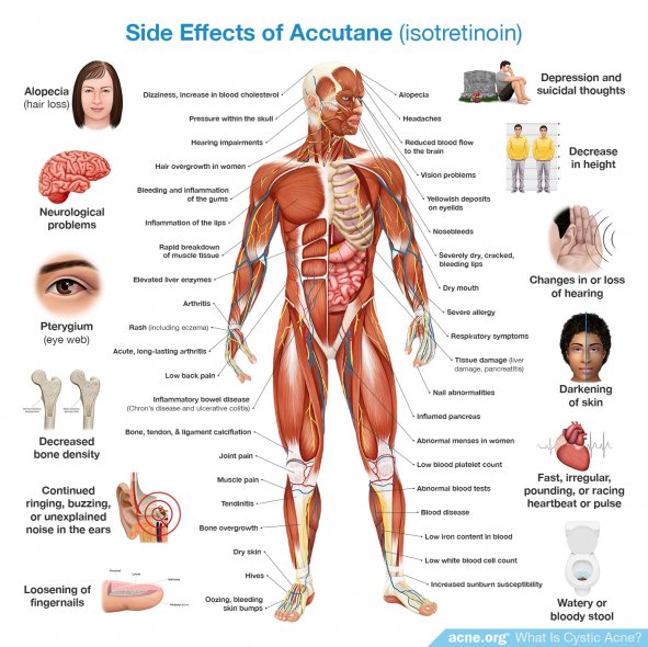 Side Effects of Accutane (isotretinoin)
