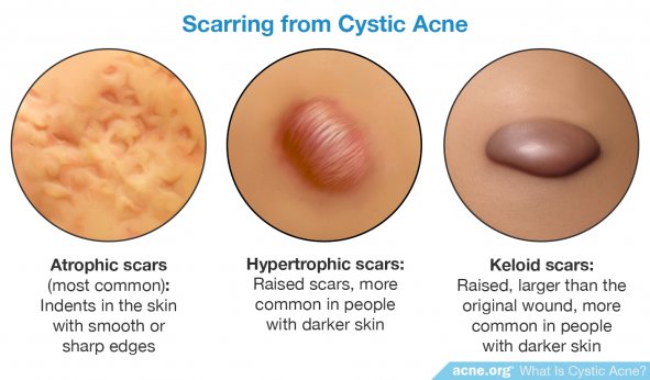 Scarring from Cystic Acne