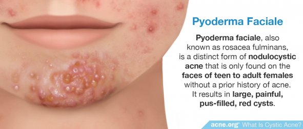 Pyoderma Faciale