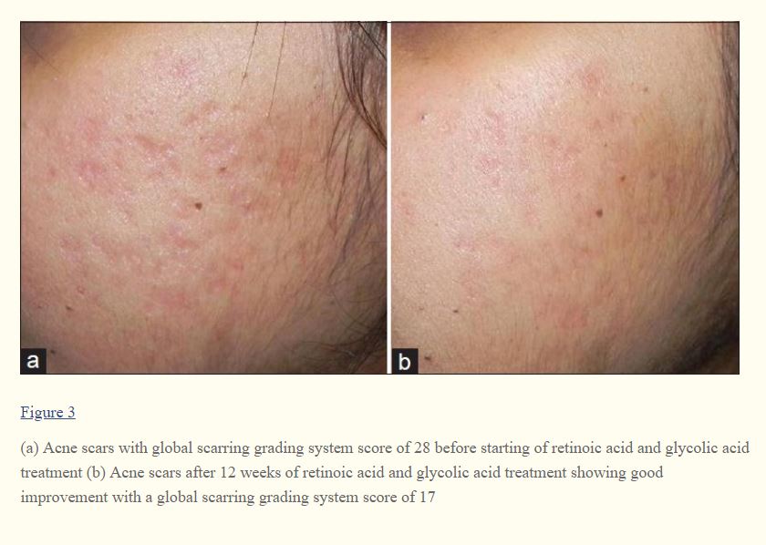 Study Of Retinoic Acid Glycolic Acid Topical On Scar Really Good 