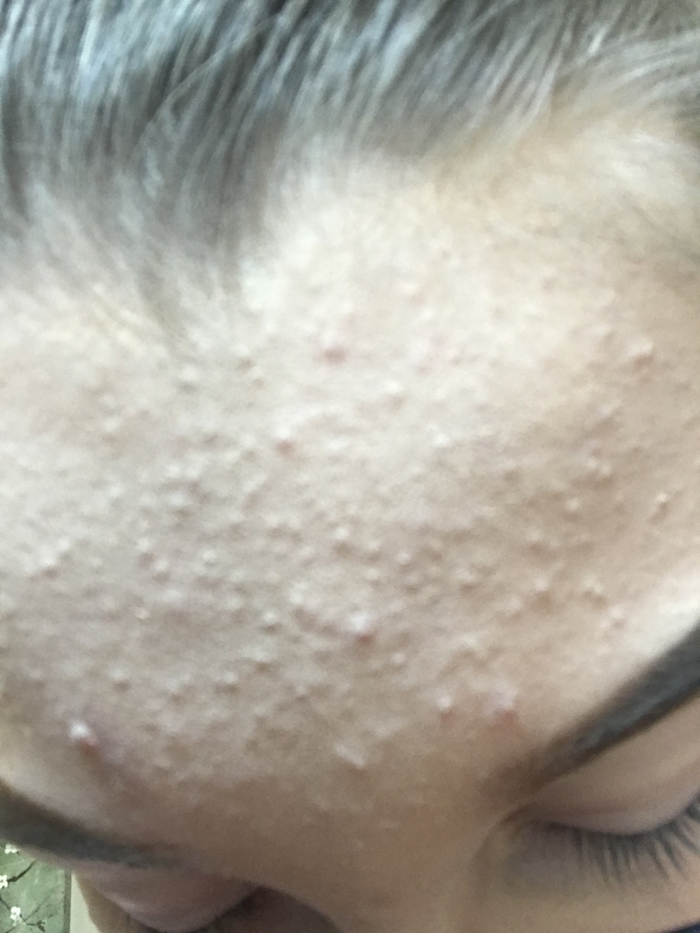 Tiny Bumps All Over Forehead General Acne Discussion