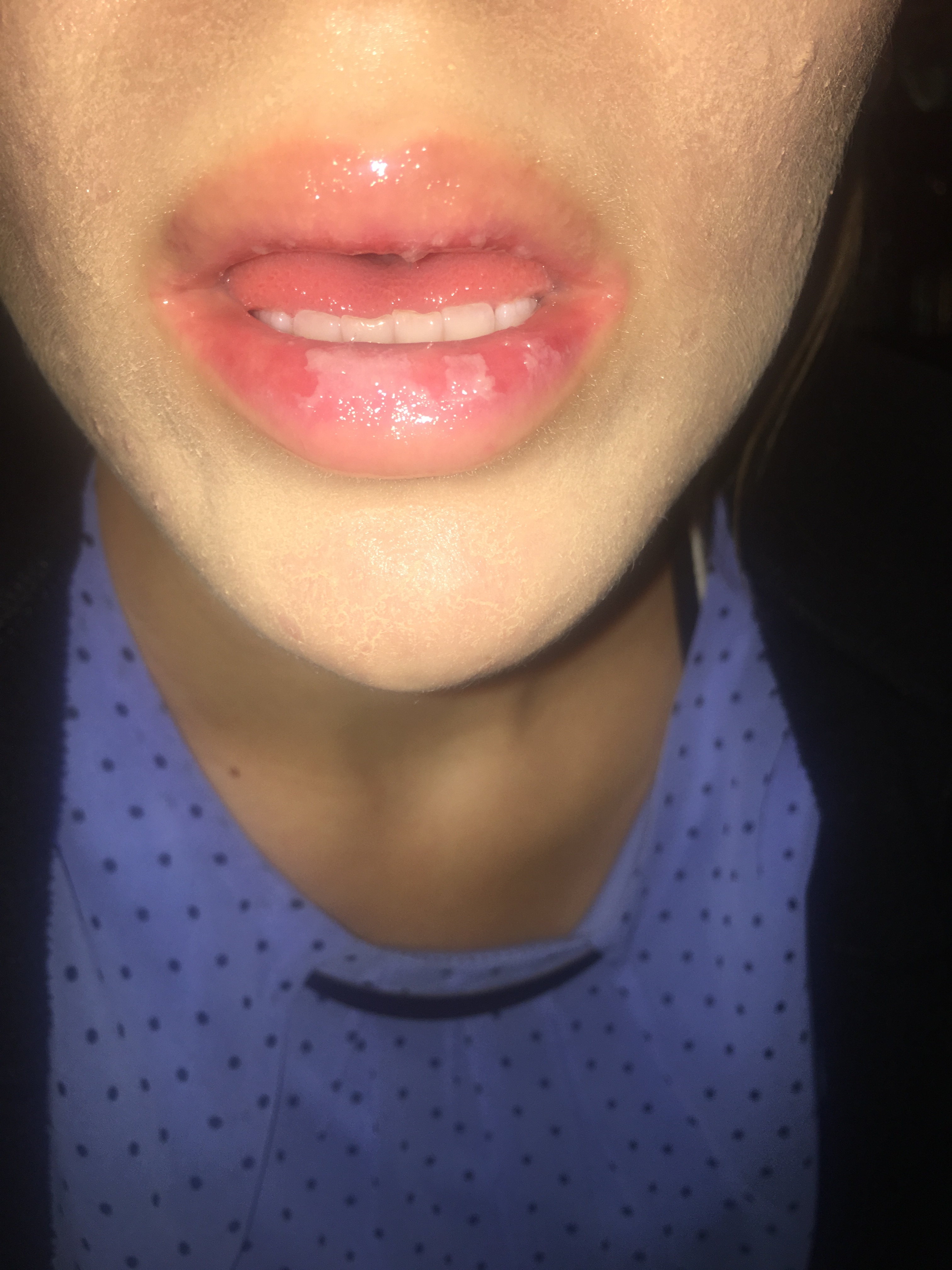 Spot on lip: Causes, symptoms, and treatment