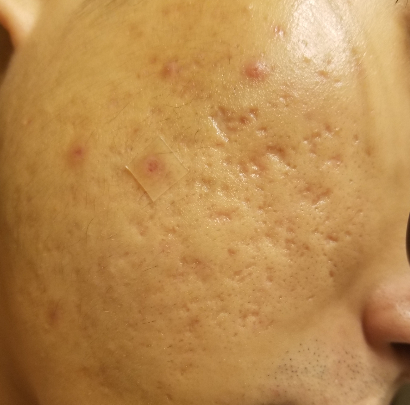 Need Serious Advice For My Acneacne Scars Scar Treatments By