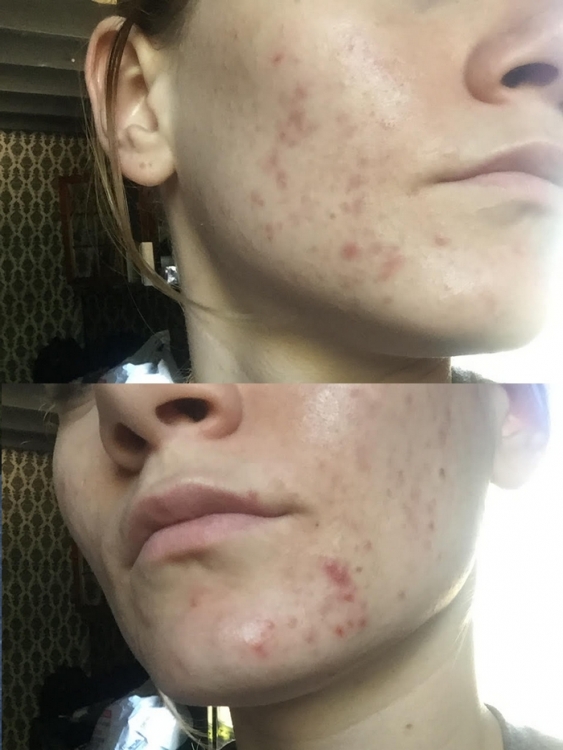 acne.thumb.jpg.3568d249b41a1dc854dd38e982ef72c3.jpg