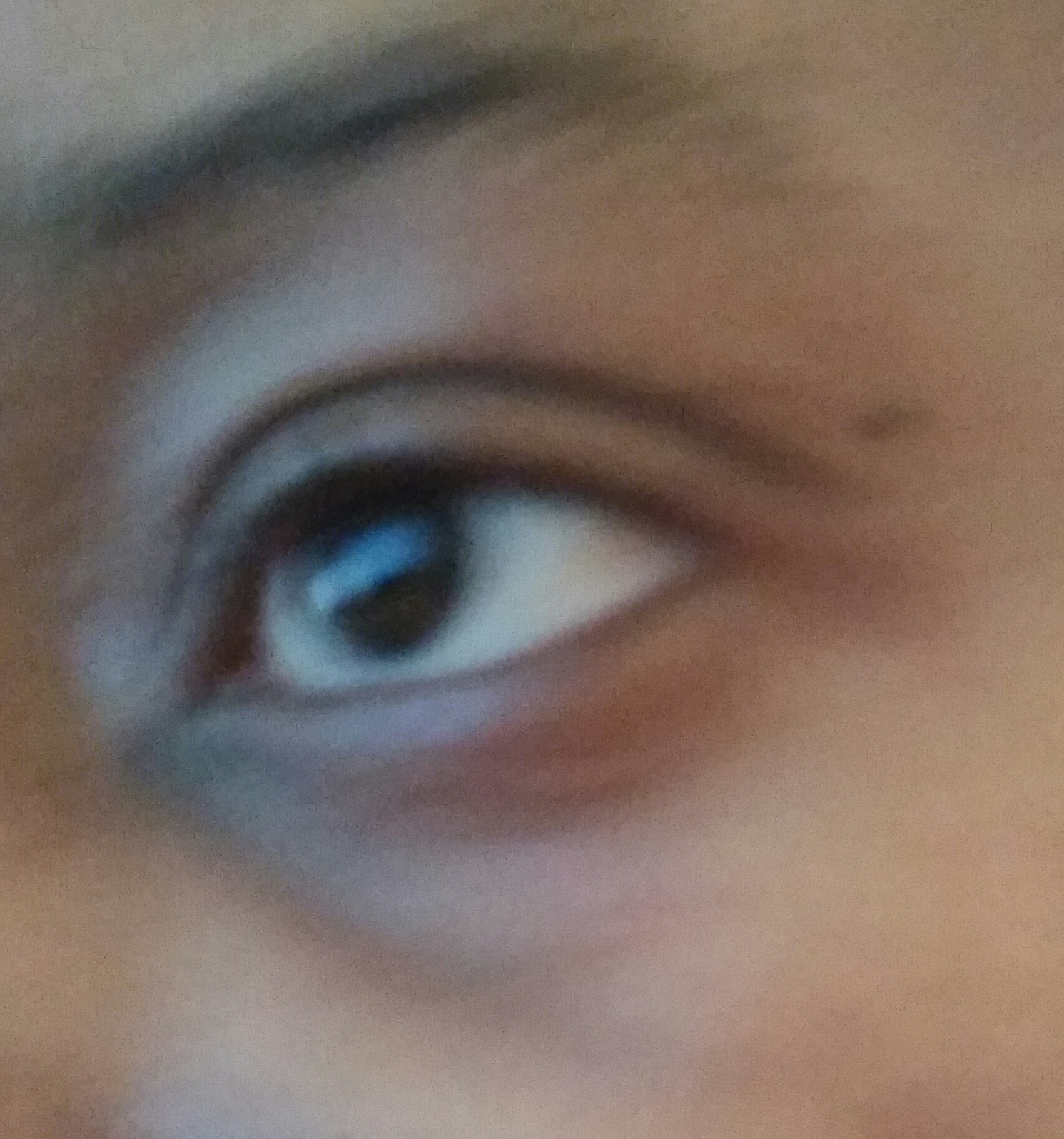 eyes dark accutane under cause can circles