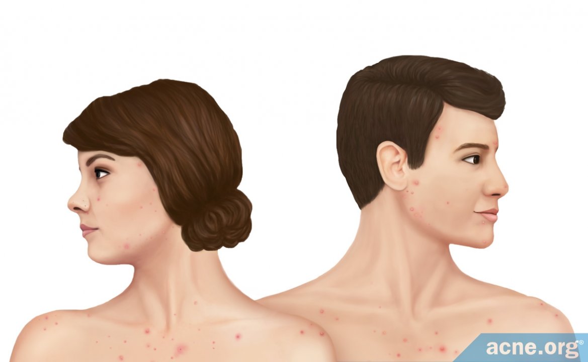 Adult Acne - Everything You Need to Know