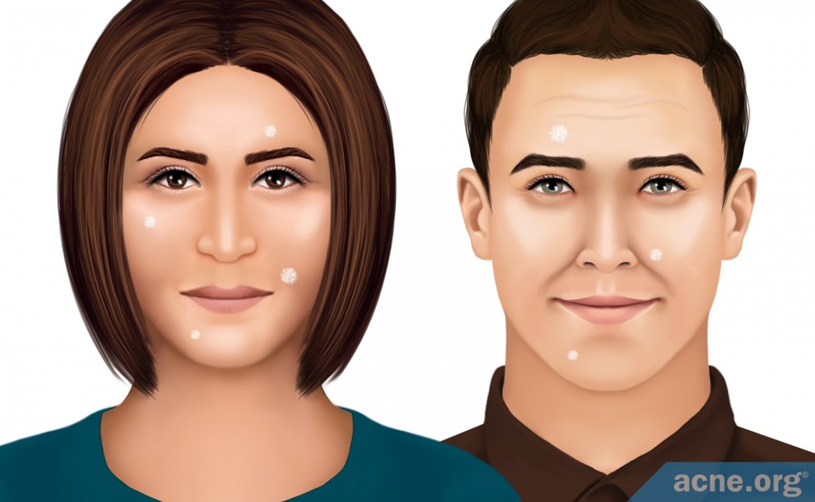 How to cure acne or acne on the face and why do they appear How to cure acne or acne on the face and why do they appear