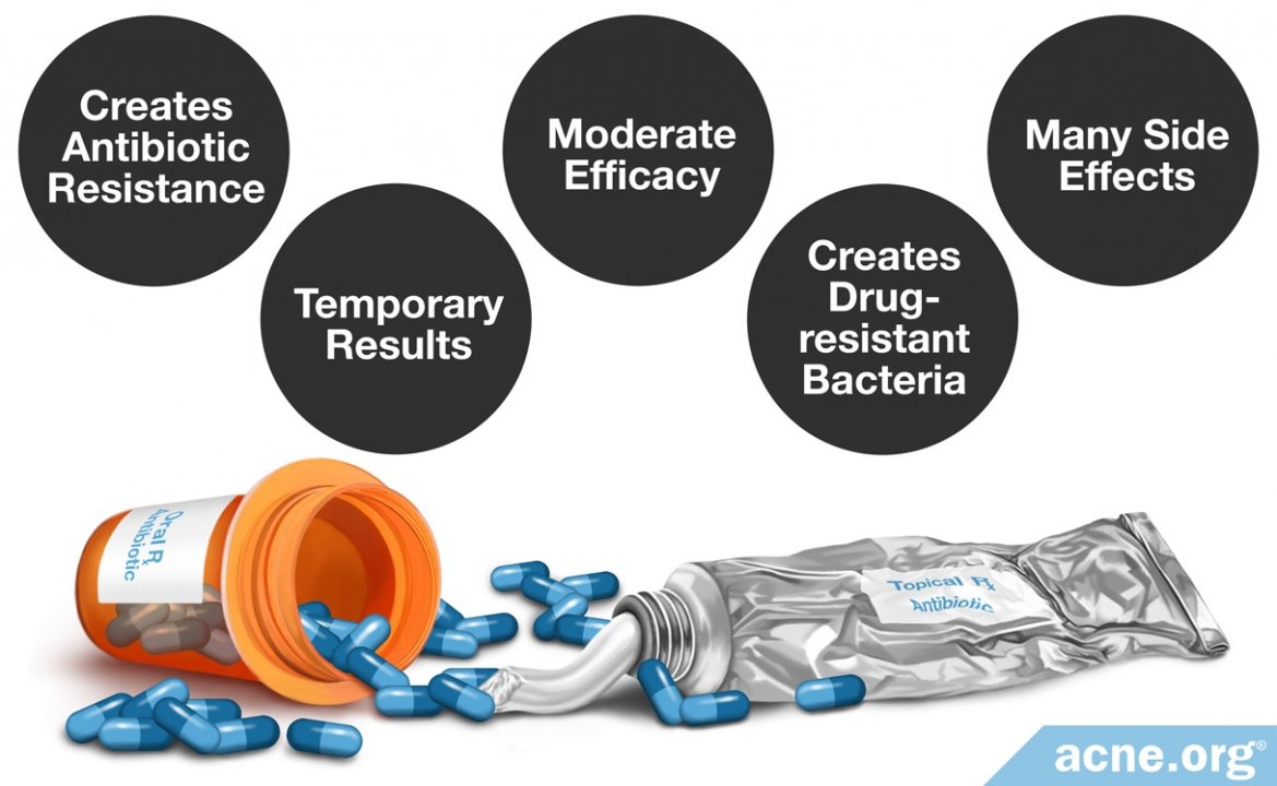 Are Antibiotics a Good Idea for the Treatment of Acne?