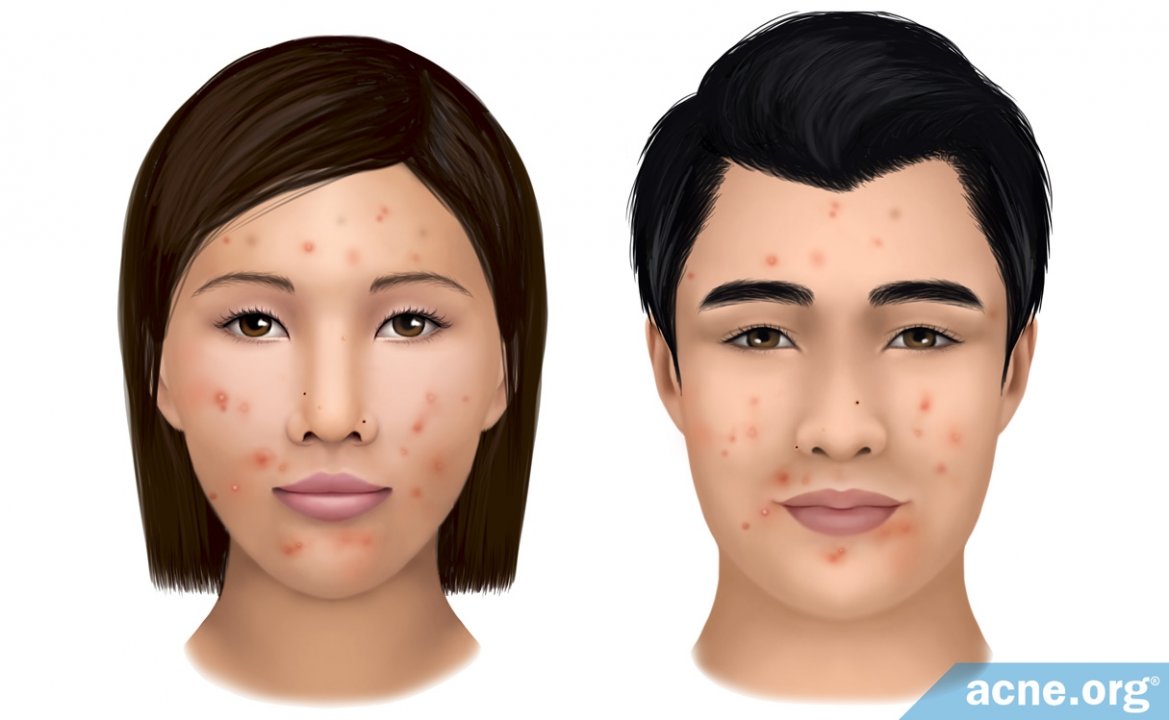 Asian skin and acne
