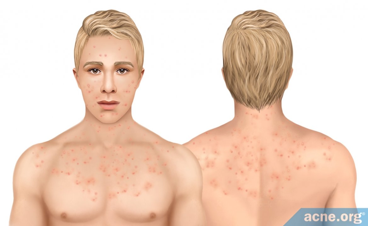 Back and Body Acne