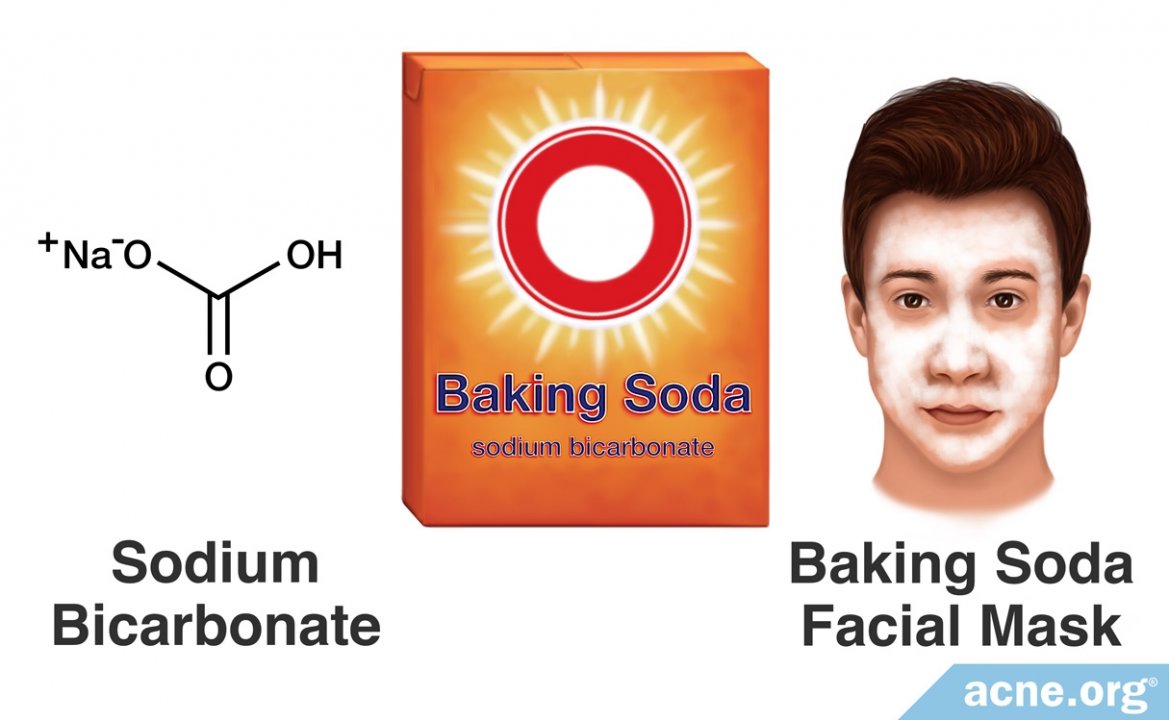 Baking Soda and Acne
