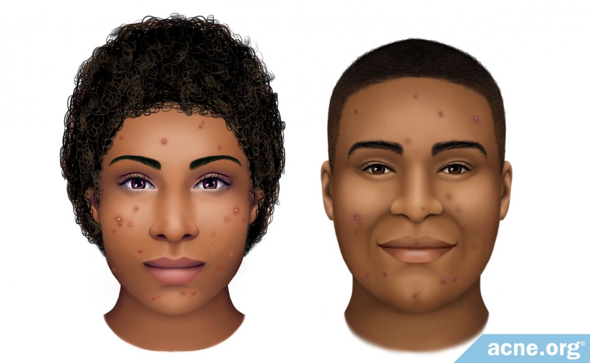 Black Skin and Acne