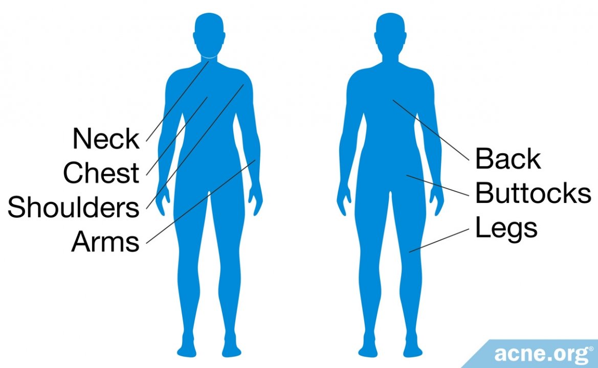 Body Acne Is More Common Than You Think