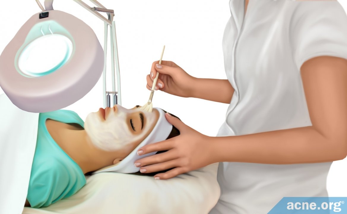 Chemical Peels for Acne