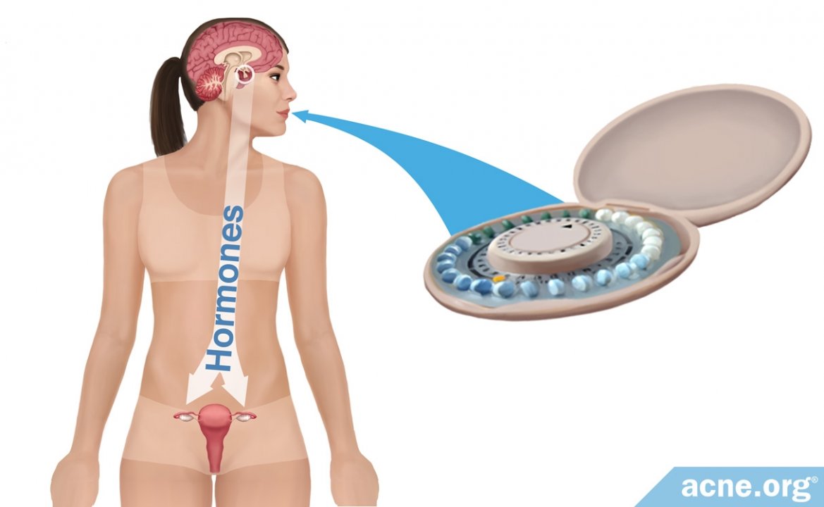 Do Birth Control Pills Clear Acne?