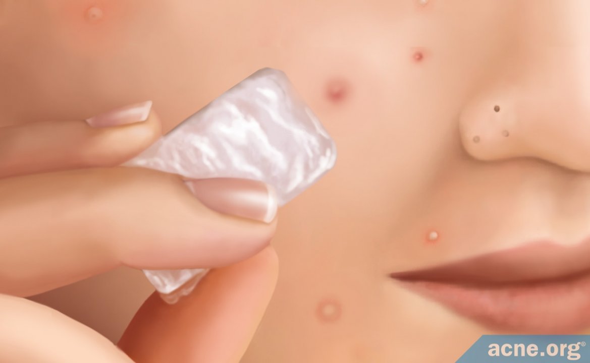 Does Ice Help to Heal Acne?