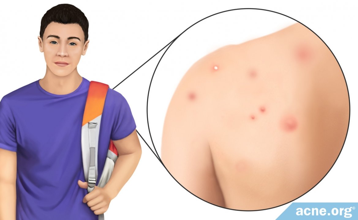 Does Physically Irritating the Skin Cause Acne?
