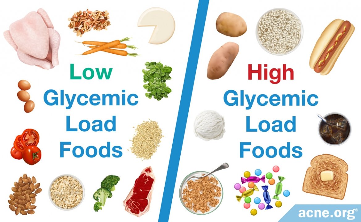 Glycemic Load Diet and Acne