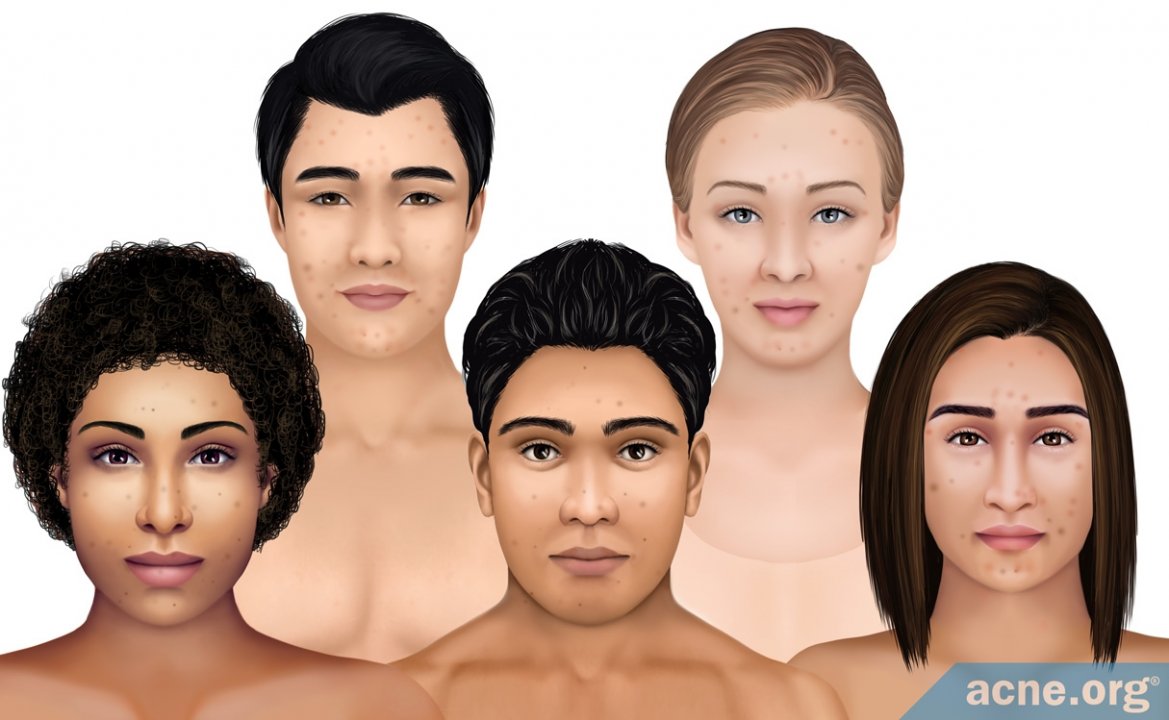 Handling Hyperpigmentation