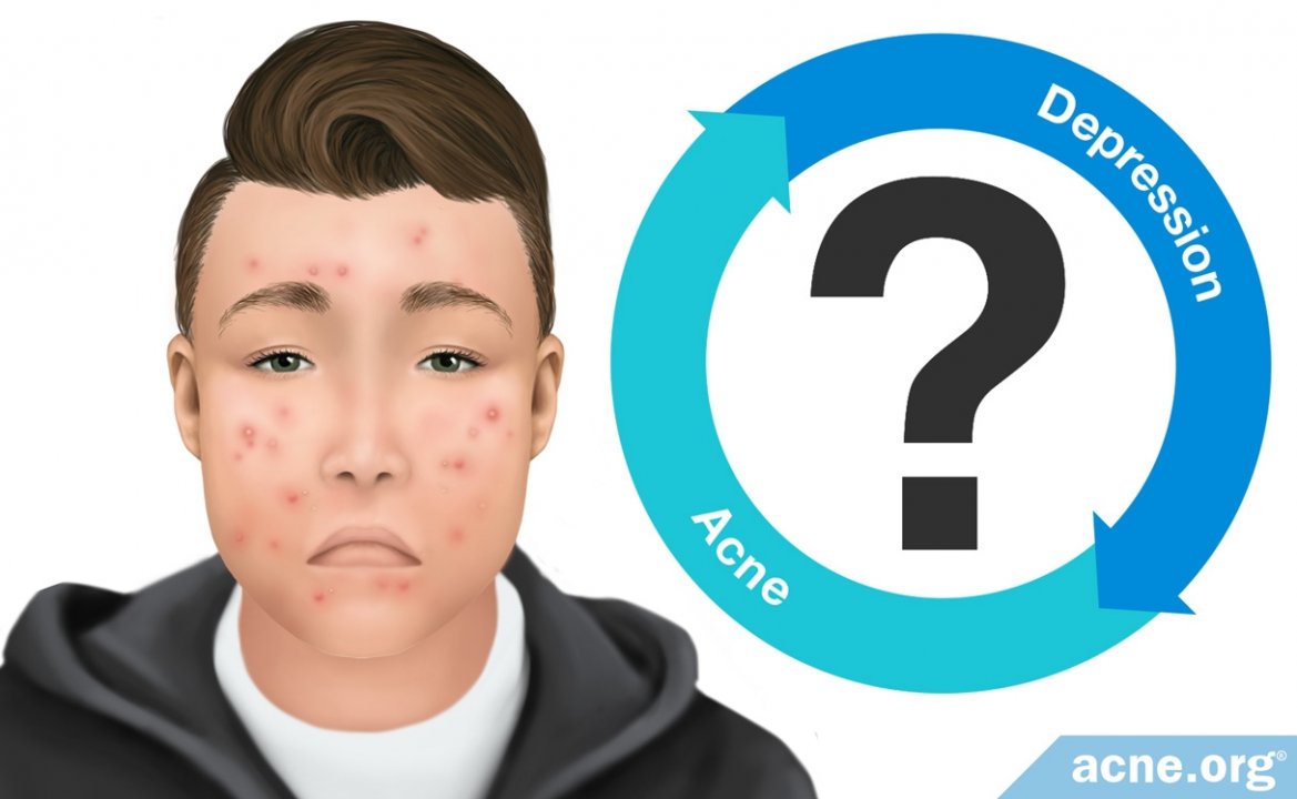 How Are Acne and Depression Related?