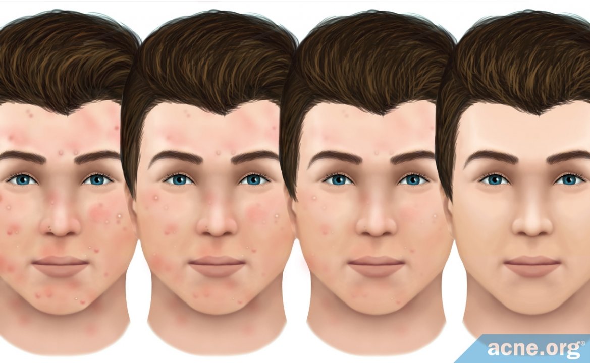 How Do Acne Lesions Heal?